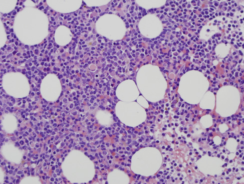 Non-Hodgkin Lymphoma