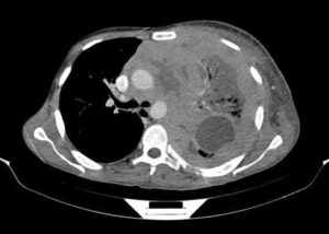 Non-Hodgkin Lymphoma