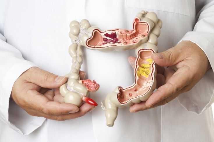 cancer de l’anus  symptômes, origine, traitement