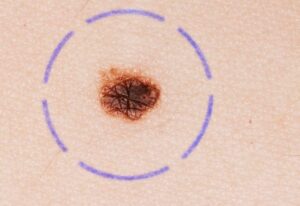 how is melanoma surgery performed