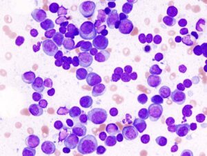 multiple myeloma