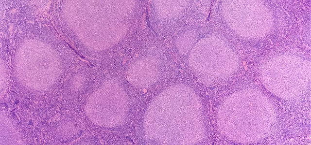 Non-Hodgkin Lymphoma