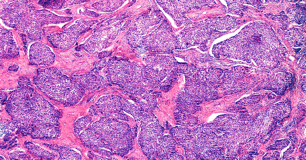 CAR-T for Solid Tumors