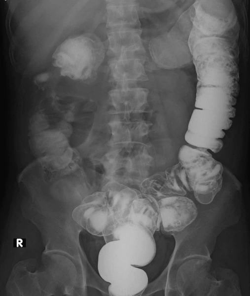colorectal cancer x ray