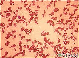 Sickle Cell