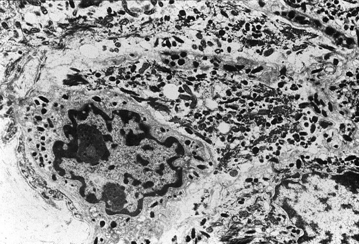 lung cancer cell