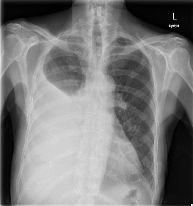 lung metastaticcancert