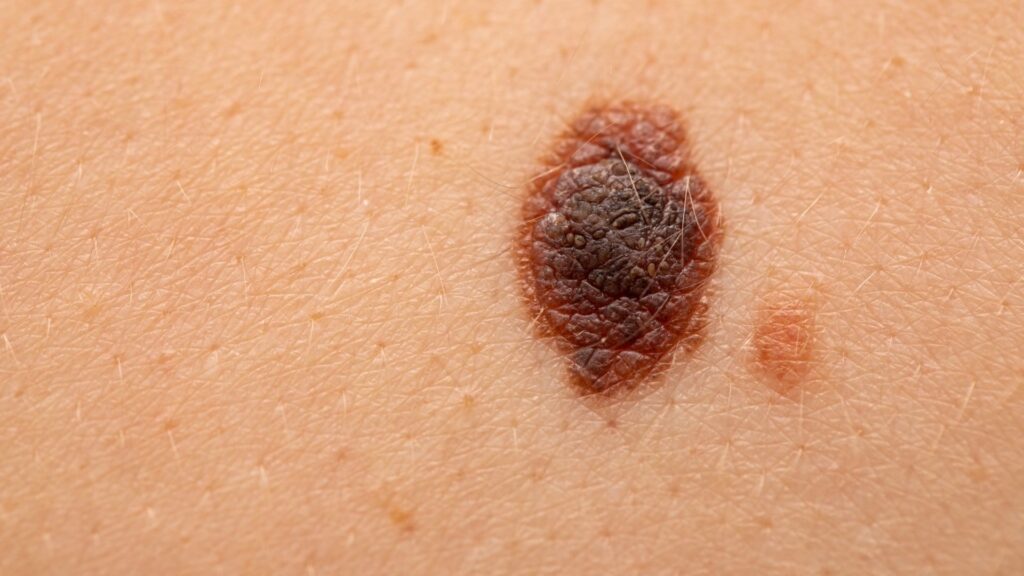 malignant melanoma 232