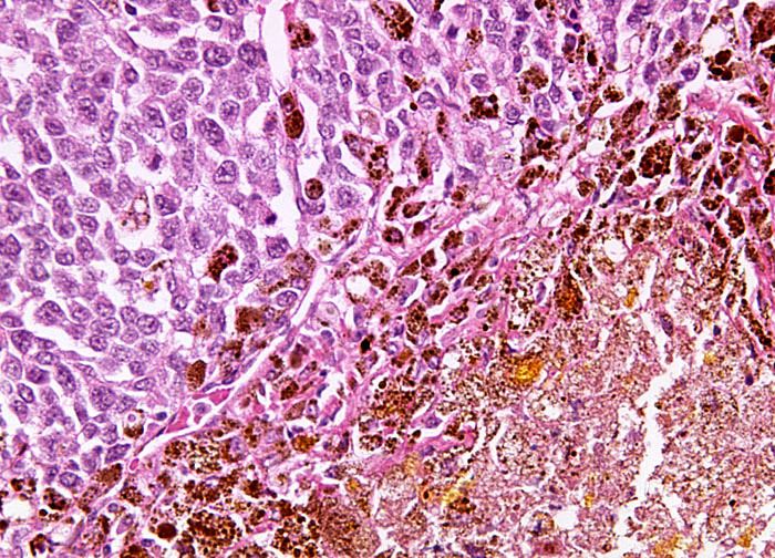 melonoma cell 23423