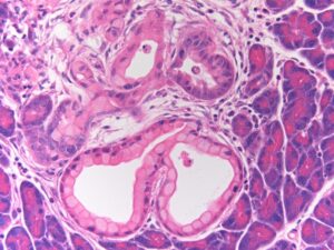 pancretic cancer cell