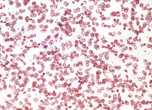 Gene Therapy