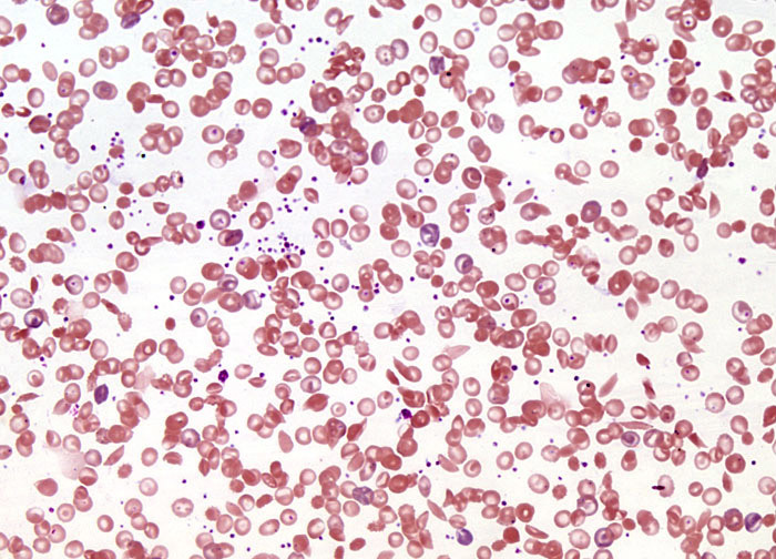 Gene Therapy