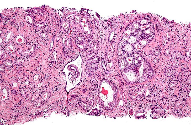 CAR-T for Solid Tumors