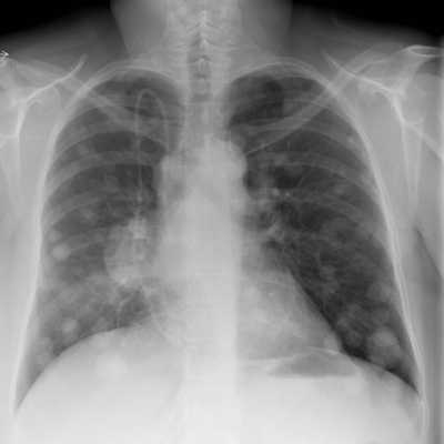 Metastatic cancer
