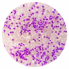 multiple myeloma