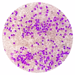 multiple myeloma