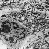 lung cancer cell