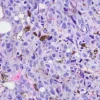 melanoma