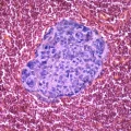 metastatic breast cancer