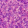 non hodgkin lymphoma