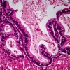 ovarian cancer