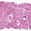 CAR-T for Solid Tumors
